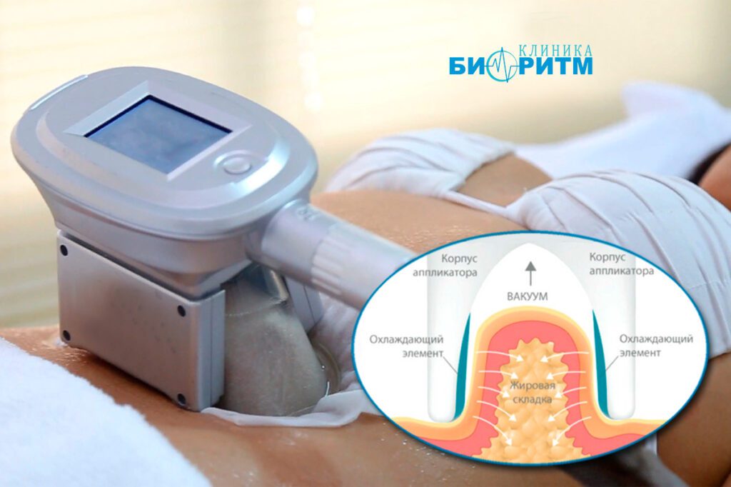 Криолиполиз, клиника Биоритм г.Дзержинск